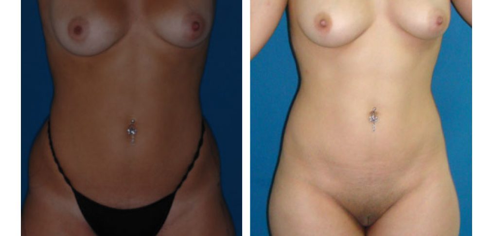 Liposuction Before and After