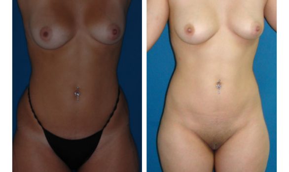 Liposuction Before and After