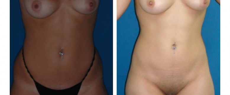 Liposuction Before and After