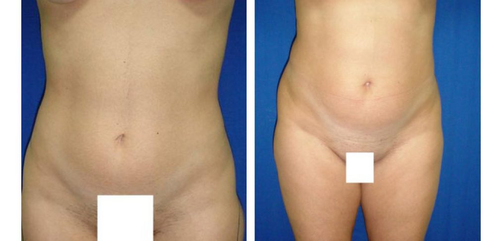 Liposuction Before and After