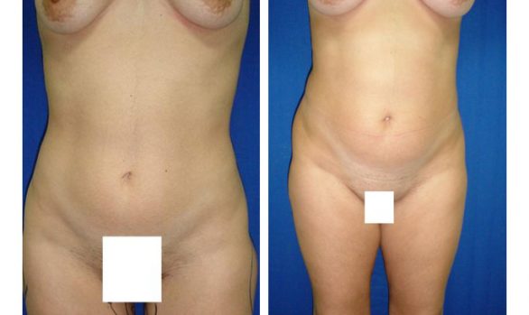 Liposuction Before and After