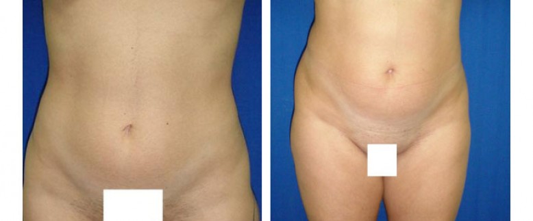 Liposuction Before and After