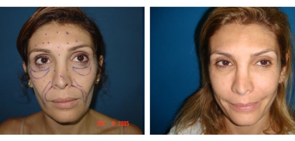 face lipofilling Before and After