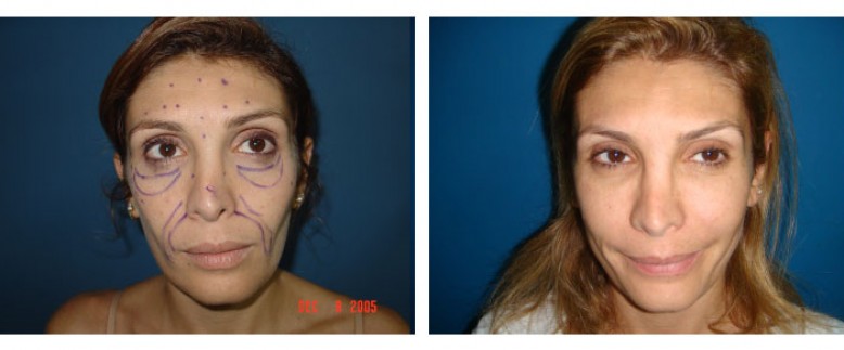 face lipofilling Before and After