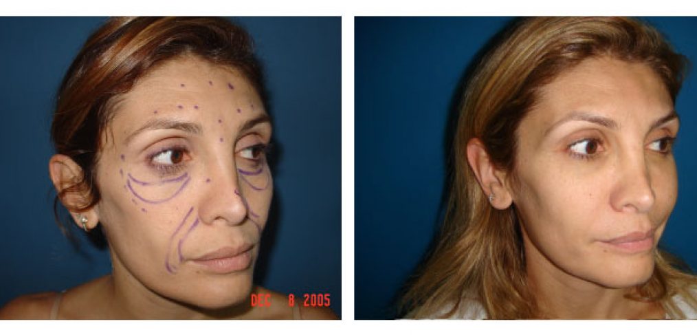 face lipofilling Before and After