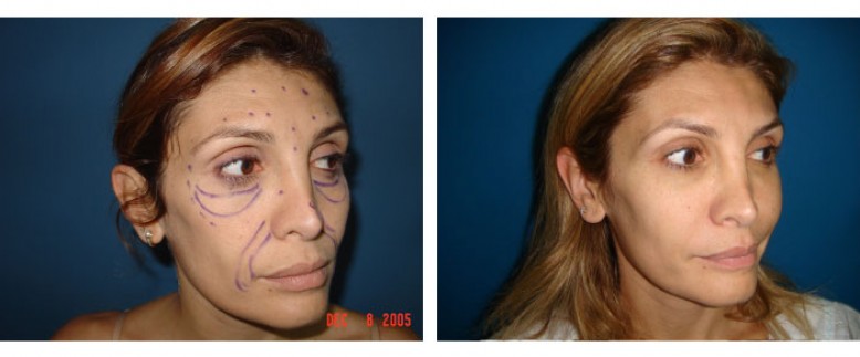 face lipofilling Before and After