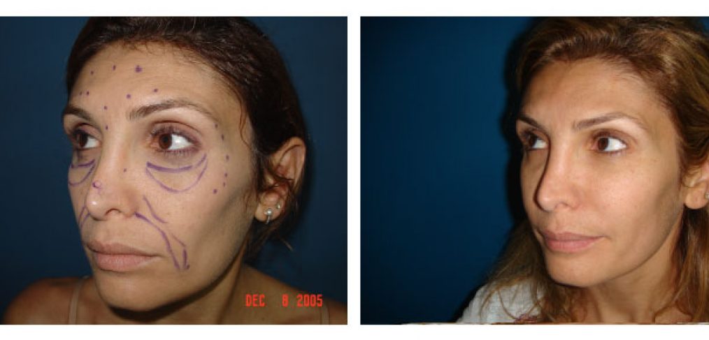 face lipofilling Before and After