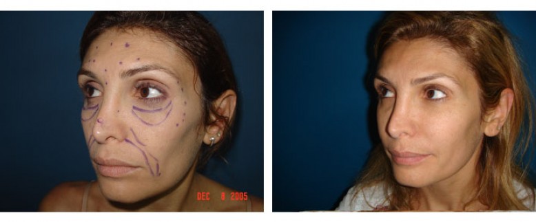 face lipofilling Before and After