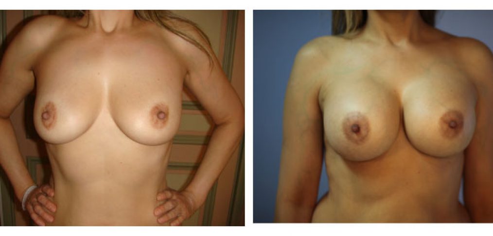 Inframammary Approach Submuscular Implants Before and After