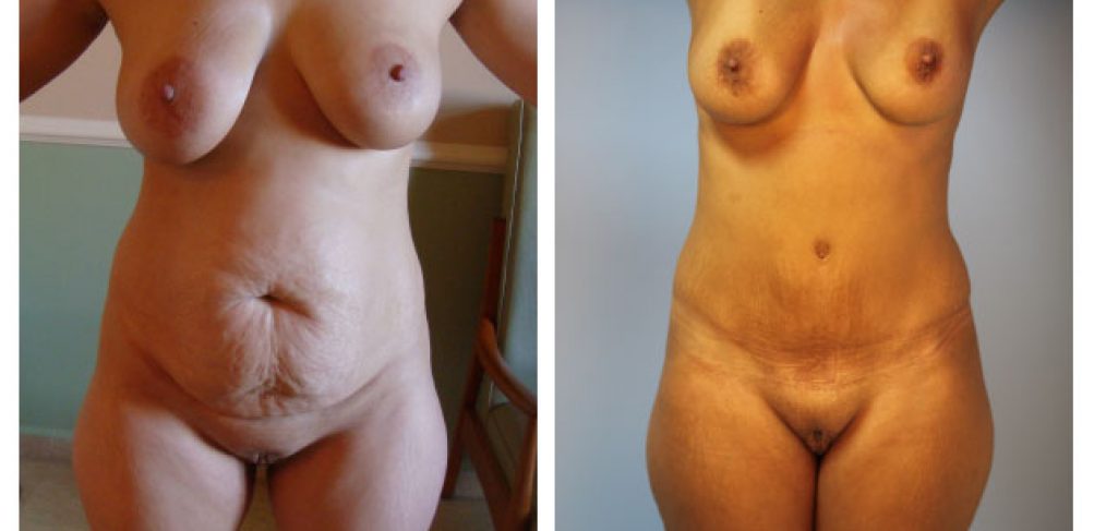 Abdominoplasty Before and After