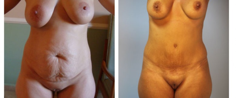 Abdominoplasty Before and After