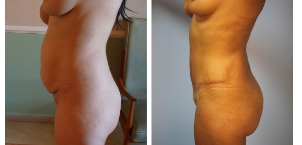 Abdominoplasty Before and After