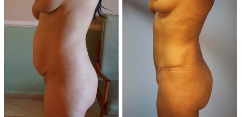 Abdominoplasty Before and After