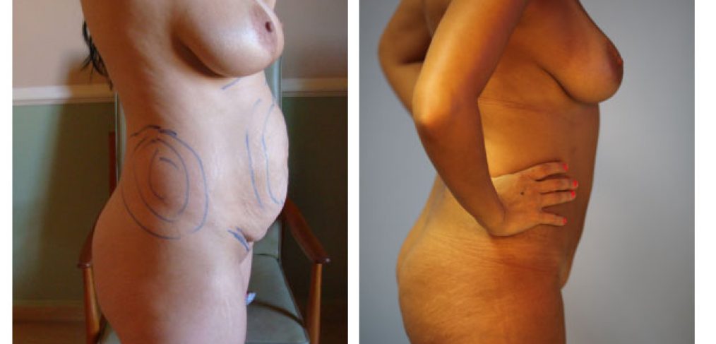 Abdominoplasty Before and After