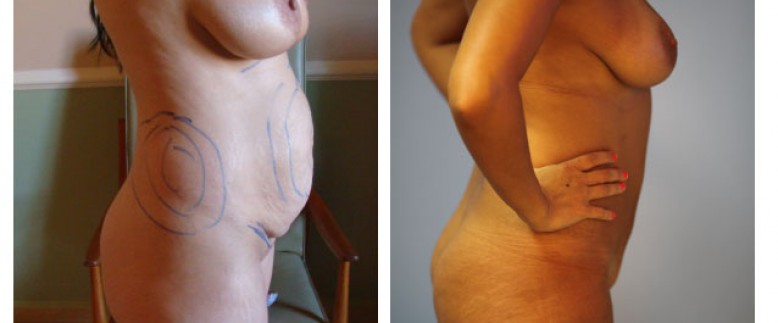 Abdominoplasty Before and After