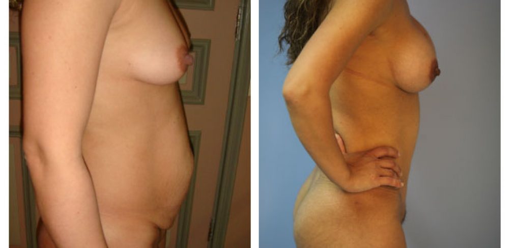 Abdominoplasty Before and After