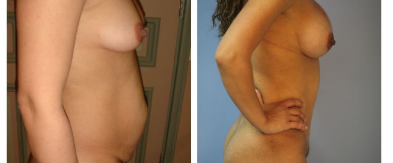 Abdominoplasty Before and After