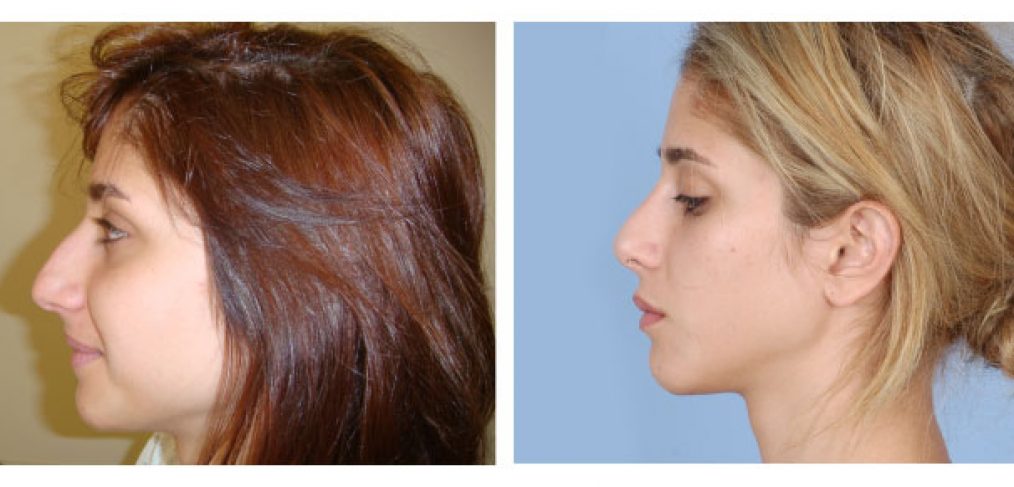 Rhinoplasty Before and After