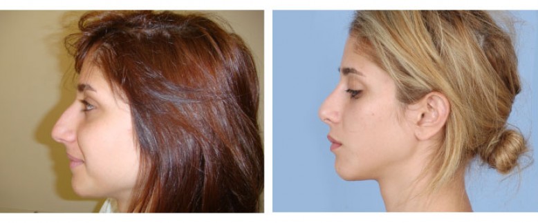 Rhinoplasty Before and After