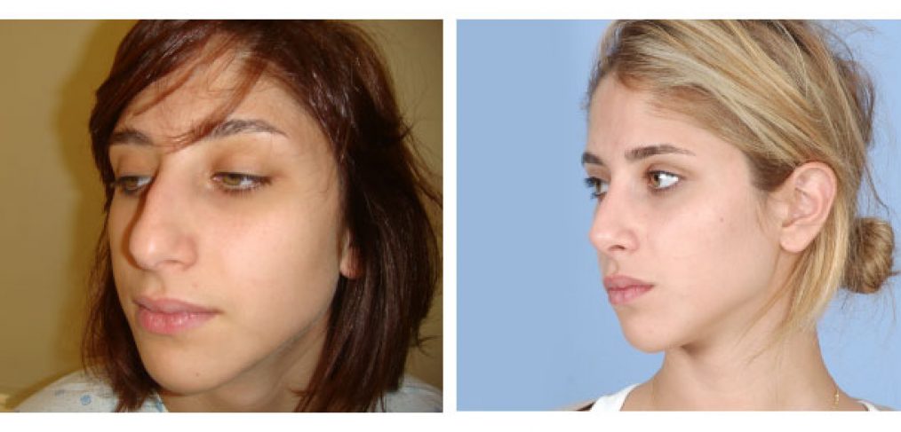 Rhinoplasty Before and After