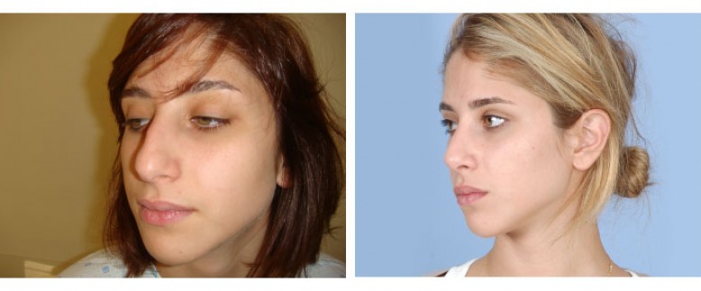 Rhinoplasty Before and After