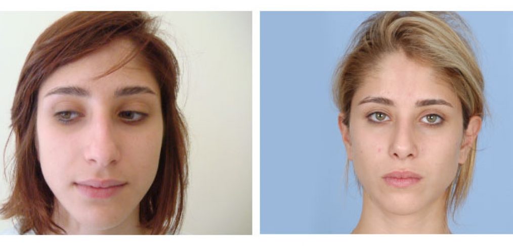 Rhinoplasty Before and After