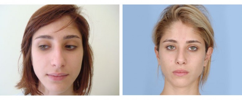 Rhinoplasty Before and After