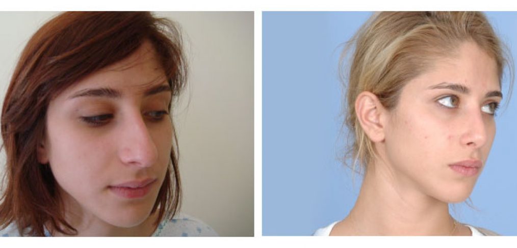 Rhinoplasty Before and After