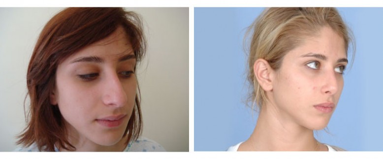 Rhinoplasty Before and After