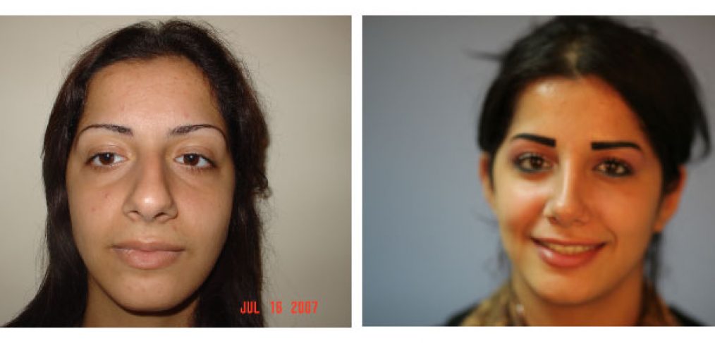 Rhinoplasty Before and After