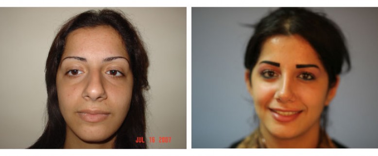 Rhinoplasty Before and After