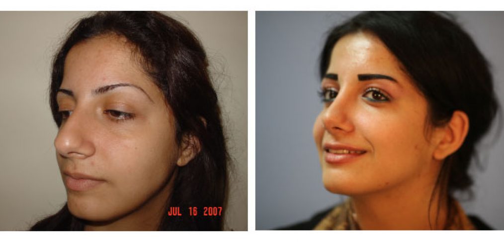 Rhinoplasty Before and After