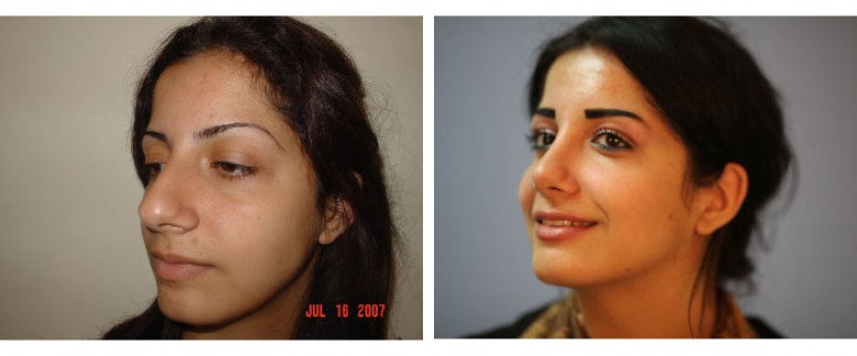 Rhinoplasty Before and After