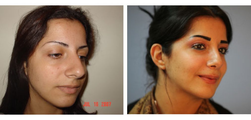 Rhinoplasty Before and After