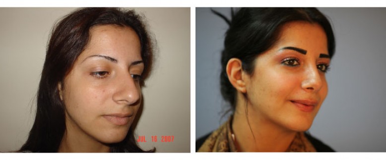 Rhinoplasty Before and After