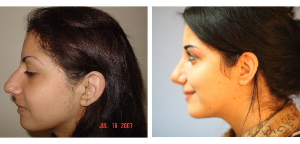 Rhinoplasty Before and After