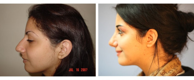 Rhinoplasty Before and After