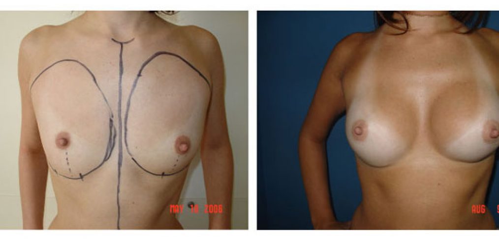 breast augmentation Before and After