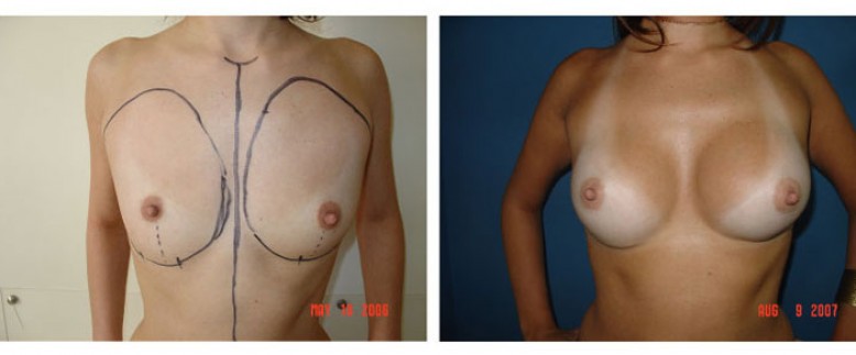 breast augmentation Before and After