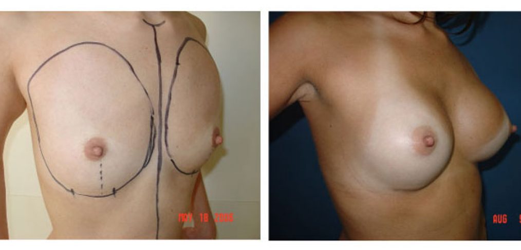 breast augmentation Before and After