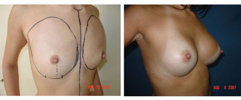 breast augmentation Before and After