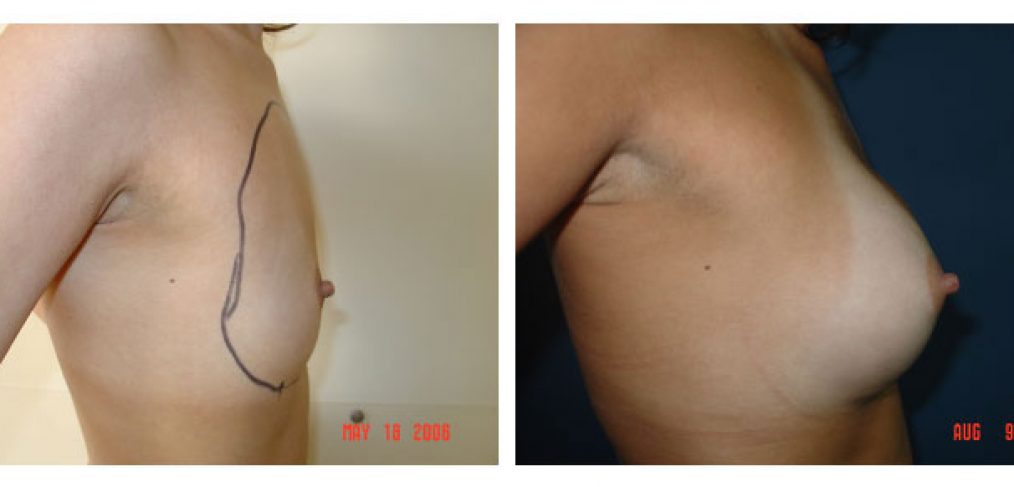 breast augmentation Before and After