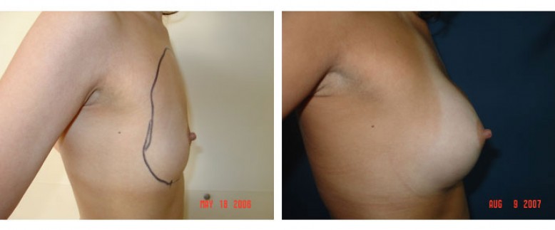 breast augmentation Before and After