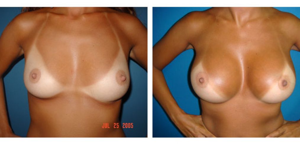 breast augmentation Before and After