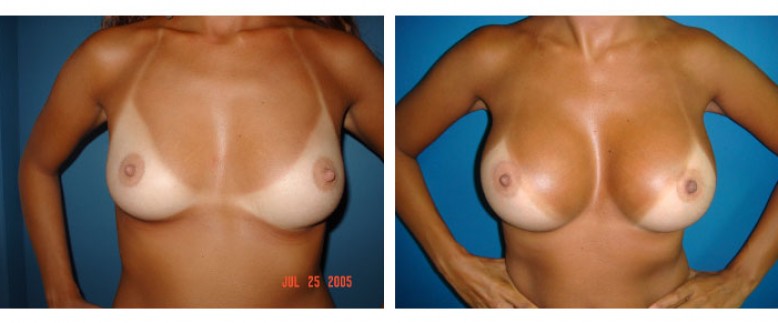 breast augmentation Before and After