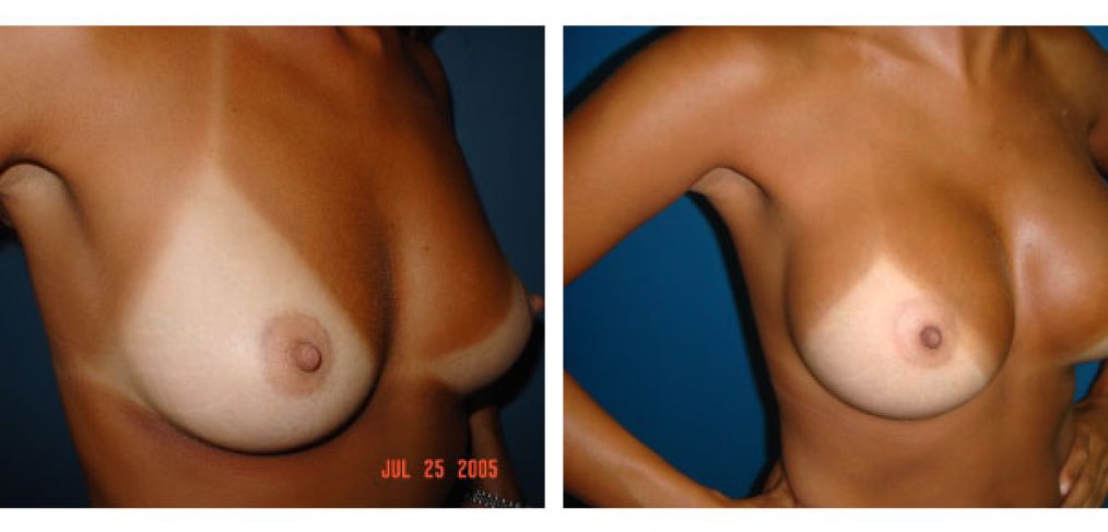 breast augmentation Before and After