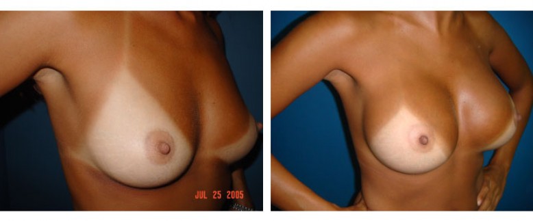 breast augmentation Before and After