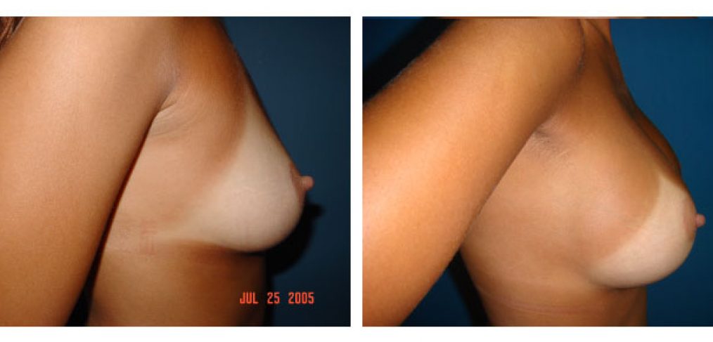 breast augmentation Before and After