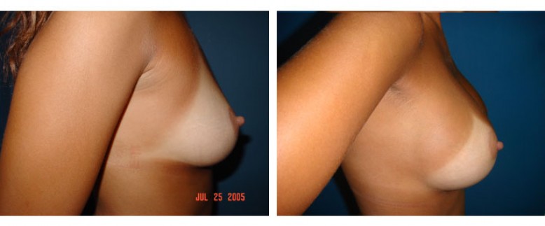 breast augmentation Before and After