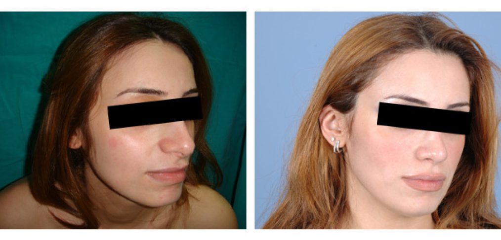 Rhinoplasty Before and After